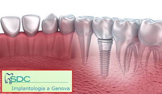 Implantologia Genova Studio dentistico dentista genova centro titanio ceramica impianto a carico immediato