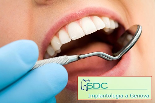 controlli dal dentista malattie parodontali carie GENGIVITE PARODONTITE pulizia dei denti Genova Studio dentistico dentista genova centro